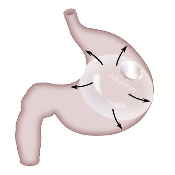 Balon-Estomago@2x-100